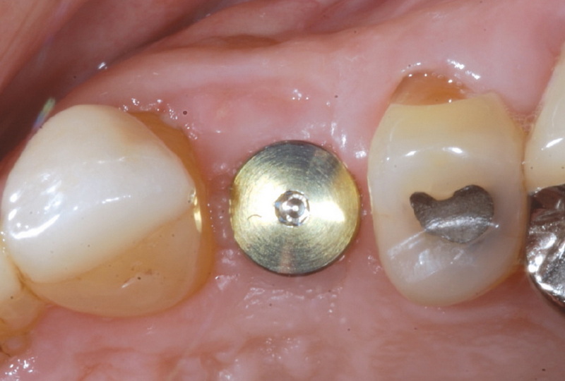 healing abutment types
