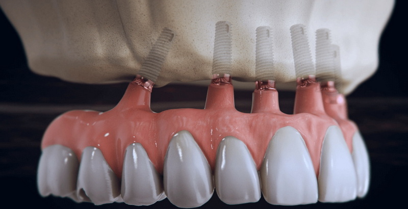 dental abutment design