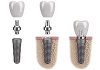 //iirorwxhloqjli5p.ldycdn.com/cloud/ljBpkKloljSRrlkllnkmjq/buy-dental-abutment-online.jpg