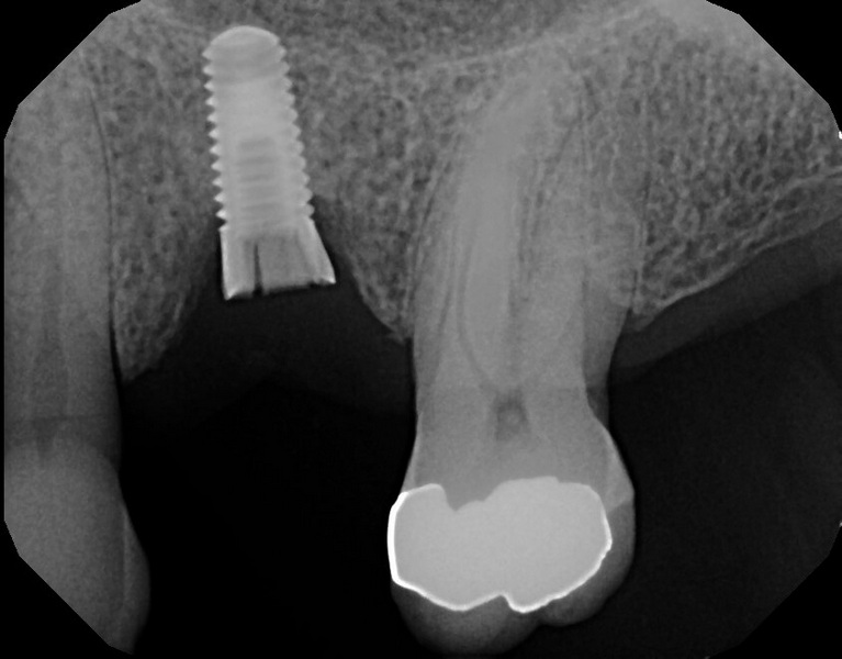 Why Choose A NobelReplace Healing Abutment for Your Implant Procedure?