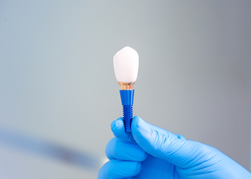 Can Indexed Abutments Prevent Rotation in Implant Restorations?