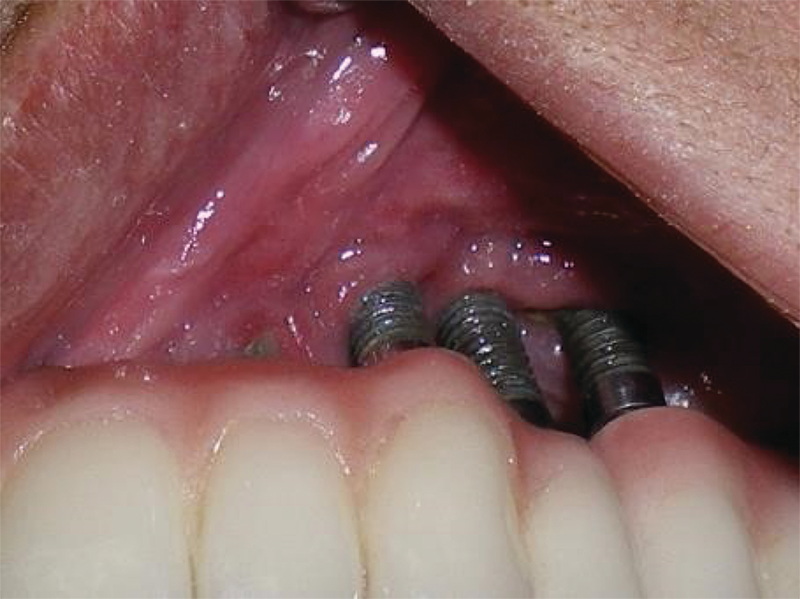Can My Dental Implant Get Infected?