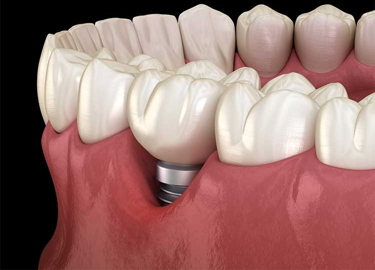 can porcelain dental implant appliance be 3d printed