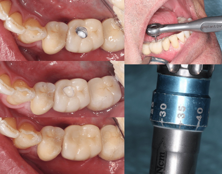abutment screw