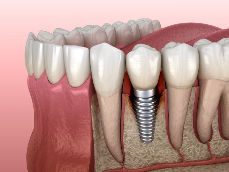can xray rule out dental implant failure