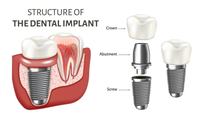 //iirorwxhloqjli5p.ldycdn.com/cloud/ljBpkKloljSRrlmkorkqjq/best-countries-for-dental-abutment-and-crown.jpg