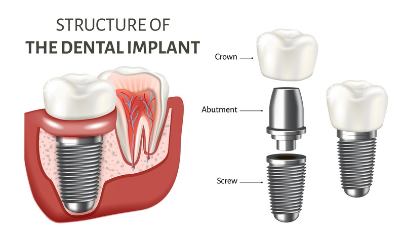 best countries for dental abutment and crown