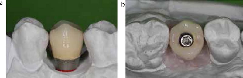 Why Do You Need A Dental Abutment After Implant Surgery?