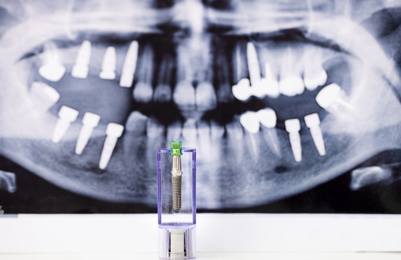 Are Stock Temporary Abutments Compatible with All Implants?