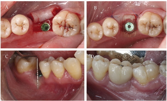 Can A Dental Implant Be Rejected?