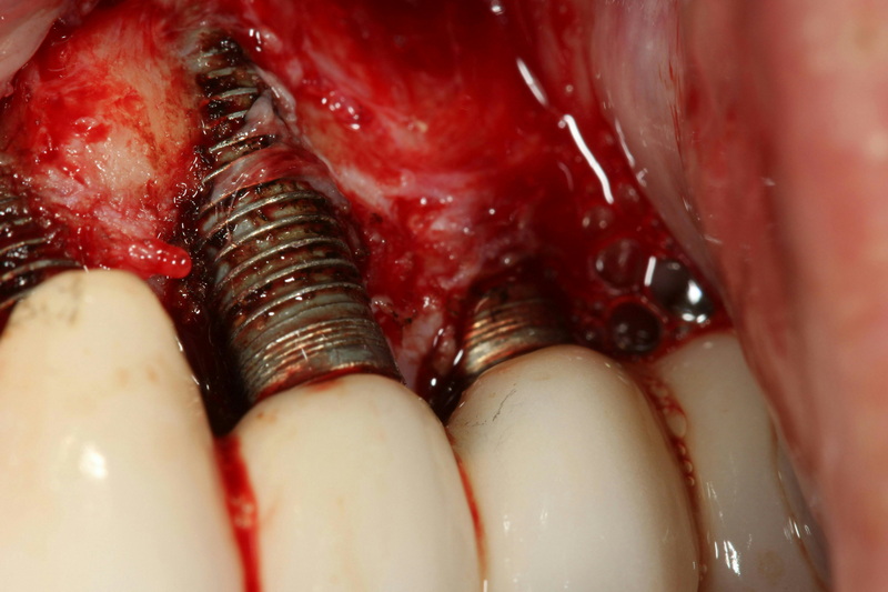 Can I Get A Dental Implant If I Smoke?