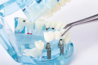 //iirorwxhloqjli5p.ldycdn.com/cloud/ljBpkKloljSRrlonqmqljp/healing-abutment-code.jpg