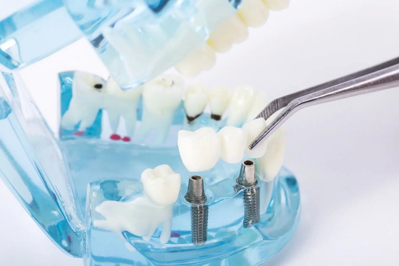 What Are The Common Coding Mistakes For Healing Abutments?
