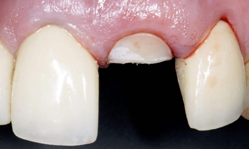 are mini dental implant fda approved