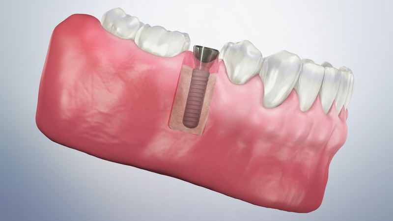 are the screws removed after dental implant