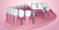 //iirorwxhloqjli5p.ldycdn.com/cloud/ljBpkKloljSRrlrljlrpjo/anatomic-healing-abutment.jpg