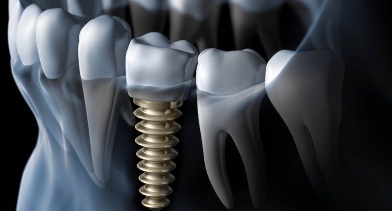 what are the signs of dental implant failure