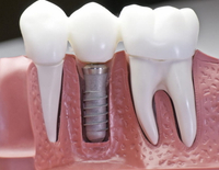 //iirorwxhloqjli5p.ldycdn.com/cloud/lkBpkKloljSRillilnjjjo/3-5-mm-3mm-healing-abutment-zimmer.jpg