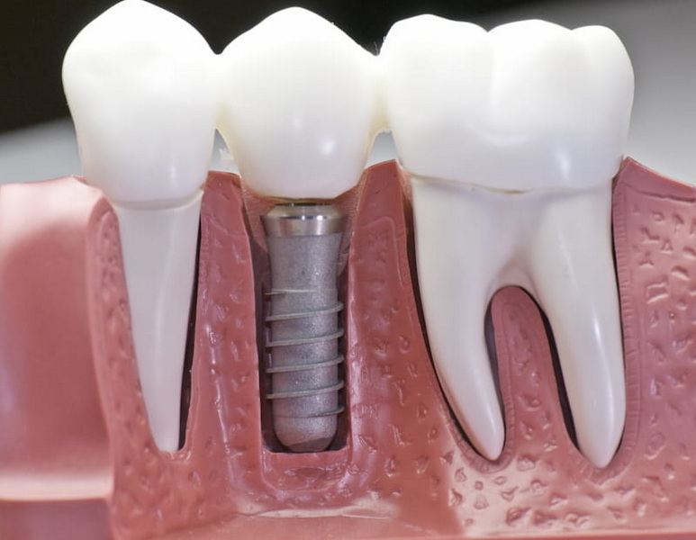 3.5 mm 3mm healing abutment zimmer