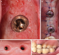 //iirorwxhloqjli5p.ldycdn.com/cloud/lkBpkKloljSRillilnqqjq/3i-healing-abutment.jpg