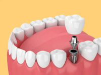 //iirorwxhloqjli5p.ldycdn.com/cloud/lkBpkKloljSRilmjonppjp/removed-stripped-implant-abutment-screw-code.jpg