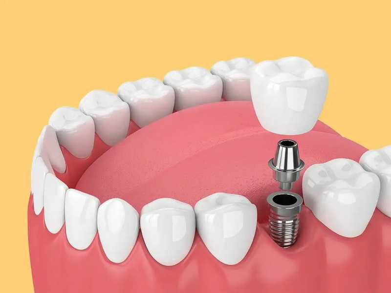 removed stripped implant abutment screw code