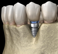 //iirorwxhloqjli5p.ldycdn.com/cloud/lkBpkKloljSRilmrniijjo/ucla-dental-abutment.jpg