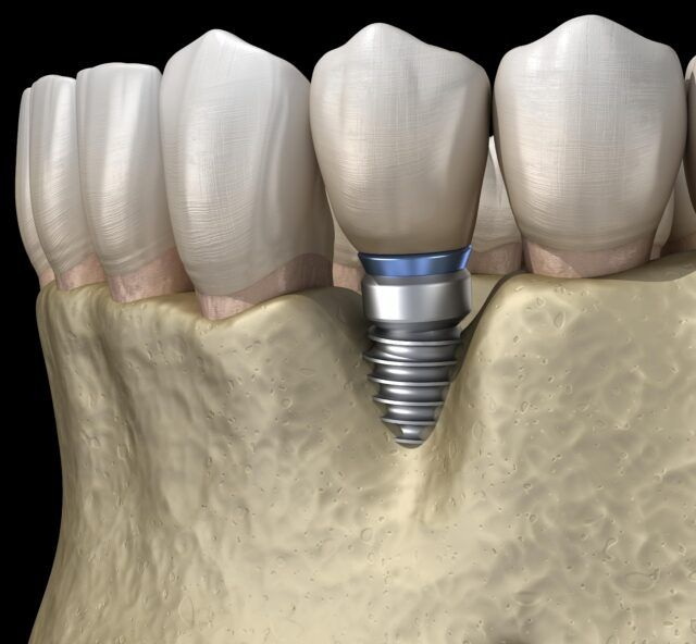 ucla dental abutment