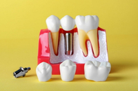 //iirorwxhloqjli5p.ldycdn.com/cloud/lkBpkKloljSRilnimrpnjq/do-you-need-a-bone-graft-for-a-dental-implant.jpg
