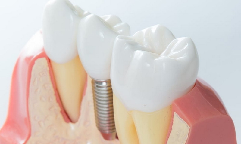 Are There New Technologies For Noninvasive Dental Implant Screw Removal?