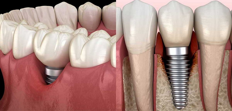 Do I Need To Take Antibiotics After Dental Implant Surgery?