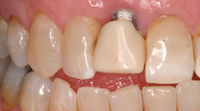 //iirorwxhloqjli5p.ldycdn.com/cloud/lkBpkKloljSRilornorijo/do-i-have-to-get-a-dental-implant.jpg