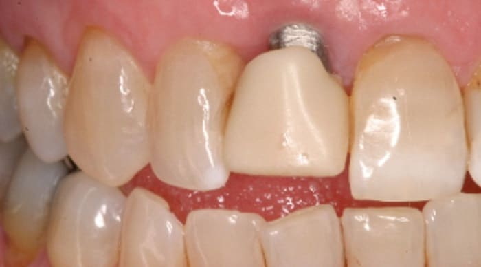 Do I Have To Get A Dental Implant?