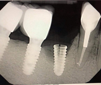 //iirorwxhloqjli5p.ldycdn.com/cloud/lkBpkKloljSRilprnnpjjq/hiossen-abutment-screw.jpg