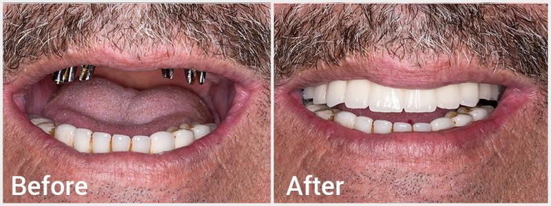 how long a dental implant lasts_07