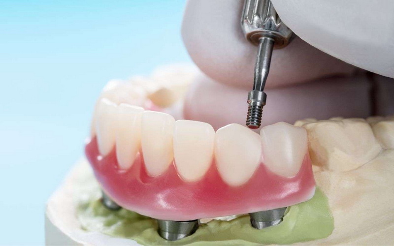 How Long Dental Implant Procedure?