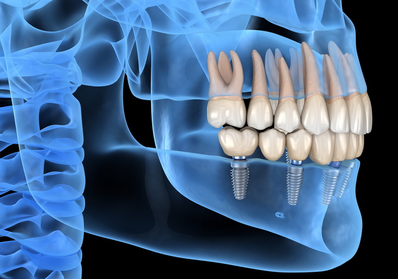 How Much Does A Dental Implant Cost at Aspen Dental?