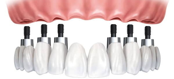 how much is a complete dental implant