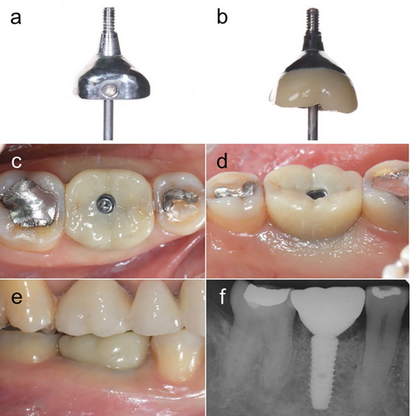 is psaltis format for implants the same as healing abutment_4