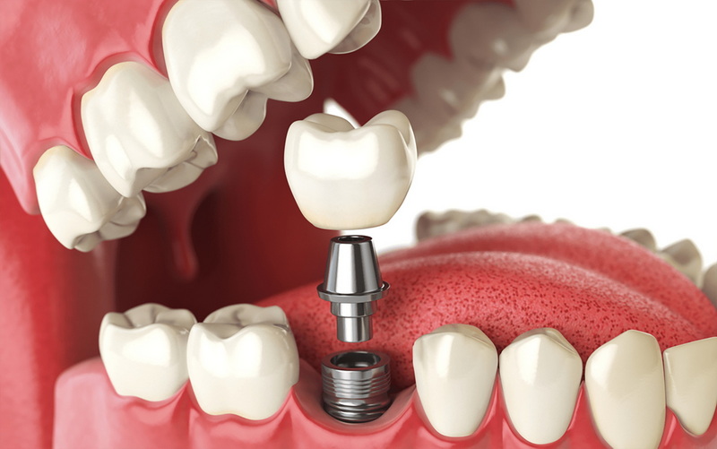 what is this dental implant_24