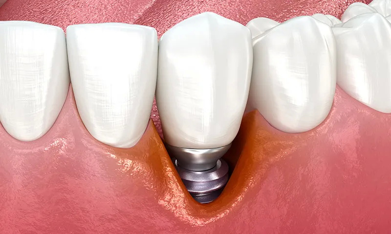 Why Is My Dental Implant Sensitive?