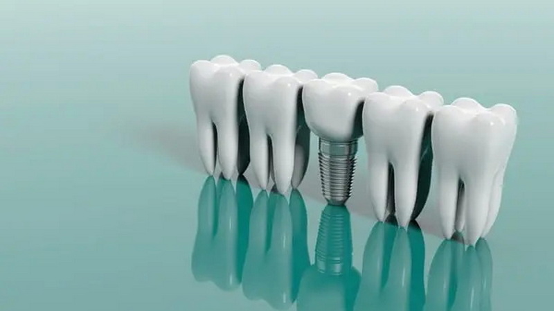 i use mouthwash after dental implant surgery_3