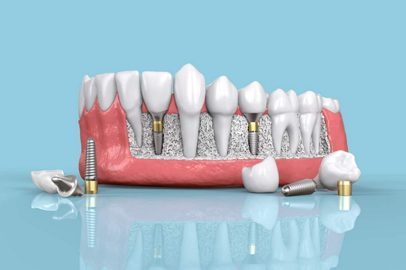 can you get a dental implant months after extraction_2