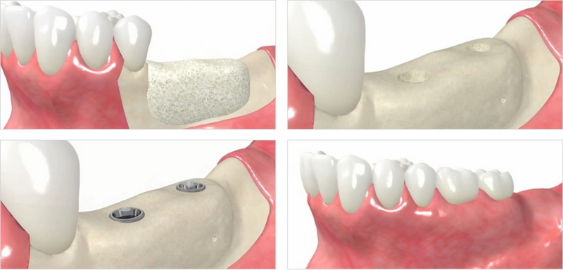  insurance cover a dental implant_1