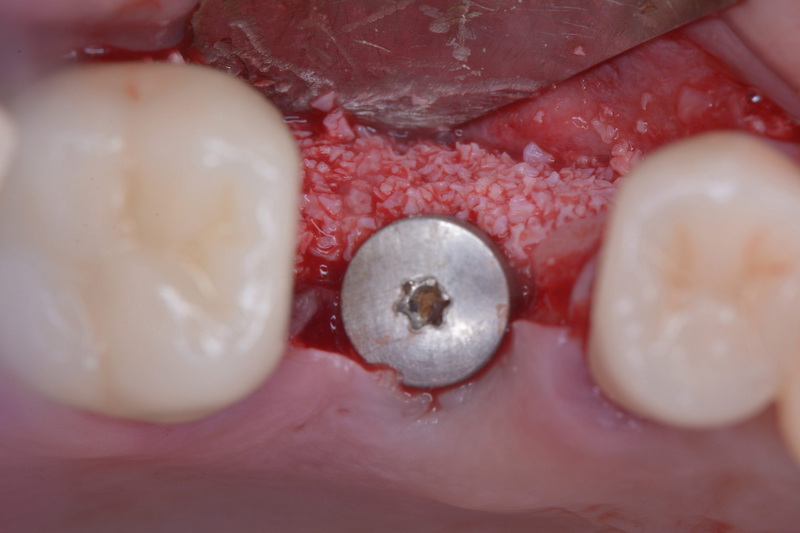 Will A Dental Implant Affect An Mri?