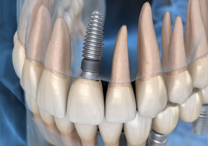 a & a dental implant and cosmetic center_4