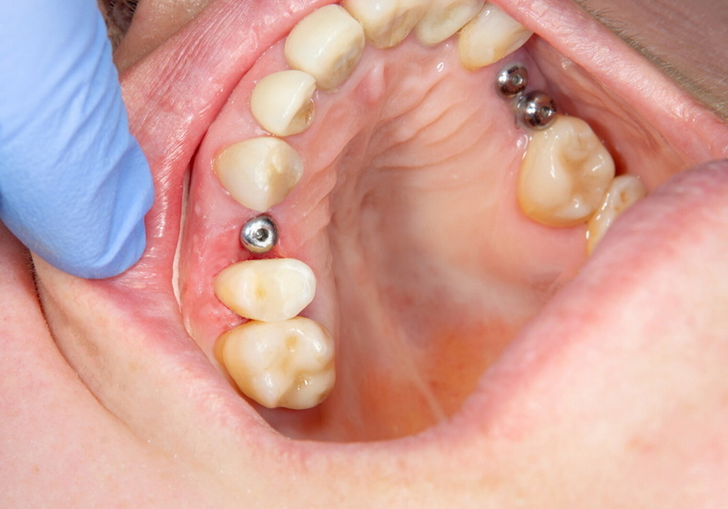 how long does it take to have a dental implant_06