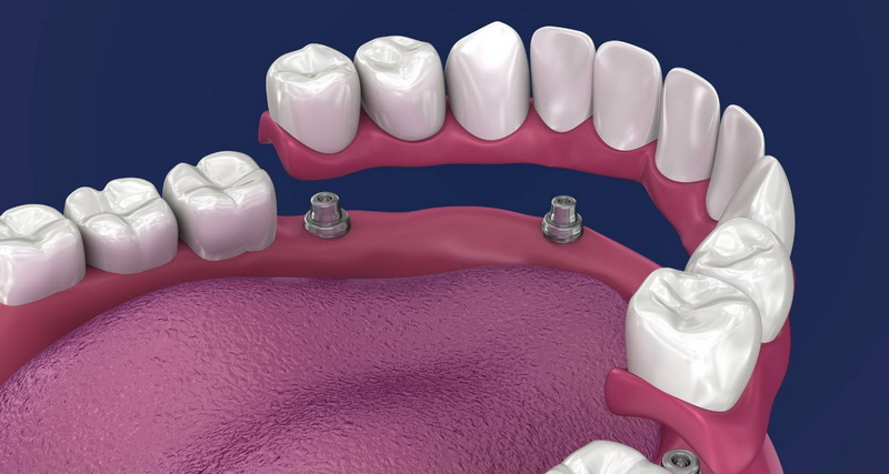 how to tell if a dental implant is failing_3