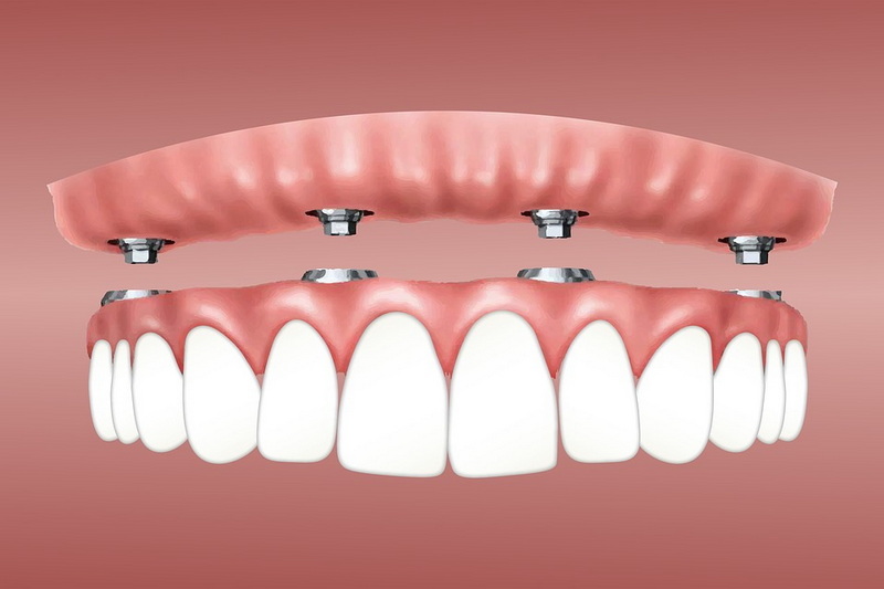 what is a dental implant arch_09