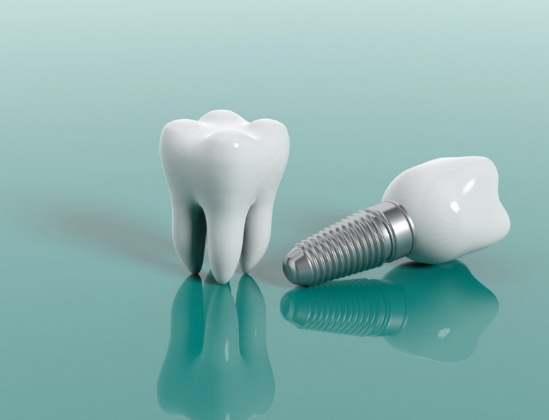 what happens when a dental implant fails_08